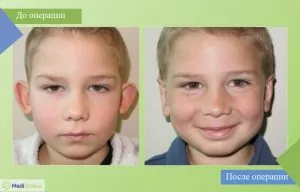 Отопластика фото до и после, Турция фото до и после отопластики