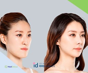 Фото до и после пластики носа в Южной Корее