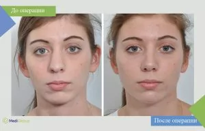 Пластическая операция на носу Фото до и после пластической операции на носу