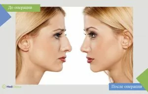 фото до и после ринопластики в Турции Пластика носа: фото до и после процедуры