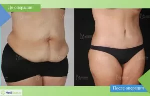 Подтяжка тела - работа доктора Сельчук Айтач Сельчук Айтач фото до после подтяжка тела