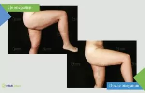 Липосакция ног - работа доктора Сельчук Айтач Сельчук Айтач - фото до после липосакция ног