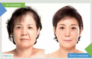 Female blepharoplasty before and after