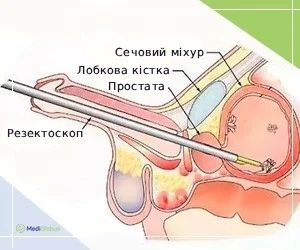 bladder_typ_ukr ТУР сечового міхура