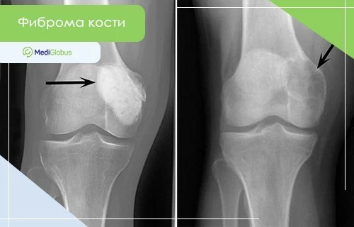 Как выглядит фиброма кости на рентгене Фиброма кости: фото на рентгене