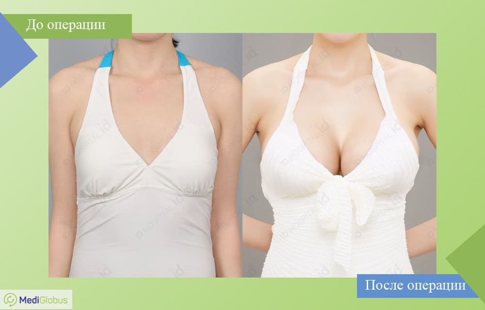 Фотогалерея увеличение груди при помощи имплантов До и После