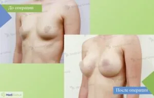 Увеличение груди, Южная Корея, JK хоспитал фото до и после операции по увеличению груди