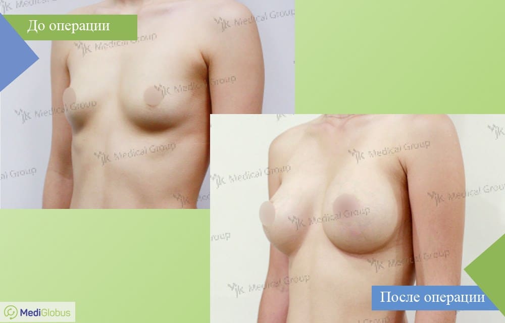 Подтяжка груди Т-образная (якорная мастопексия)