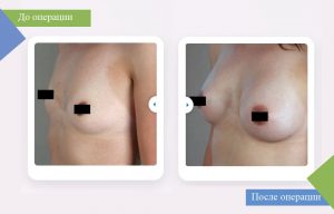 маммопластика пластика груди фото до и после турция эстетика увеличение груди