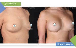 маммопластика пластика груди фото до и после турция эстетик интернешнал увеличение груди