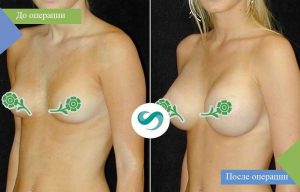 маммопластика пластика груди фото до и после турция салусс увеличение груди