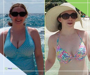 Уменьшение груди результат фото до и после