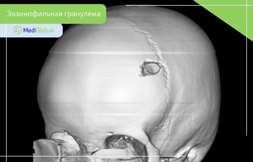 Эозинофильная гранулема — пример поражения костей, выявляемого при диагностике заболевания Трехмерная визуализация черепа с дефектом костной ткани