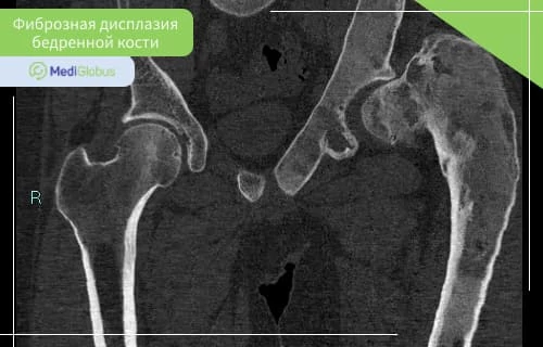 Лечение фиброзной дисплазии бедренной кости Фиброзная дисплазия бедренной кости на снимке КТ