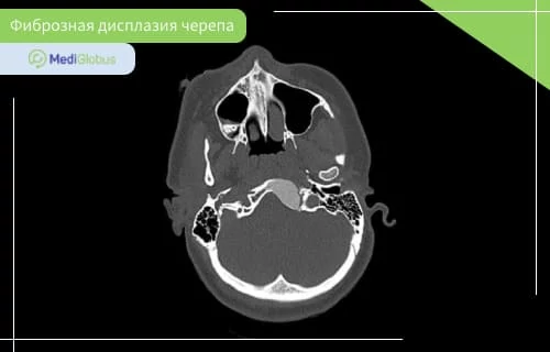 лечение фиброзной дисплазии черепа фиброзная дисплазия черепа на КТ-изображении
