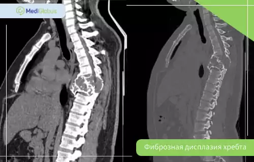 лечение фиброзной дисплазии позвоночника фиброзная дисплазия позвоночника на КТ