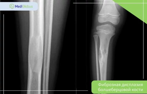 Лечение фиброзной дисплазии большеберцовой кости фиброзная дисплазия большеберцовой кости на рентгеновском снимке