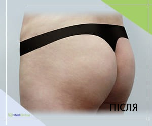 gluteoplasty_jk_after_ukr Глютеопластика (підтяжка сідниць) в Південній Кореї (JK Hospital)