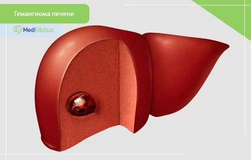 Гемангиома печени у детей 3D-изображение гемангиомы печени