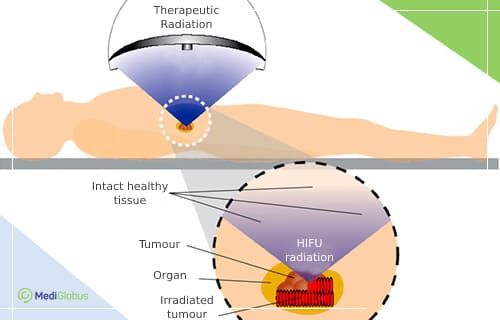 What's the Difference Between Radiation Therapy and HIFU?
