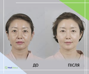 lipofilling_beforeafter_korea_ukr До та після фотографії пацієнтки що пройшла ліпофілінг обличчя в Південній Кореї