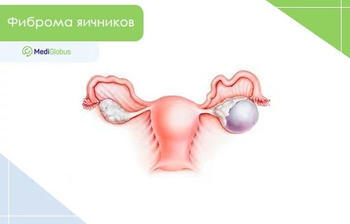 Фиброма яичников Медицинская иллюстрация женской репродуктивной системы: матка, маточные трубы и яичники; на правом яичнике показано округлое образование серо‑фиолетового цвета, обозначающее фиброму.
