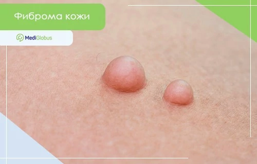 Как выглядит фиброма на коже на фото Два округлых образования на коже крупным планом