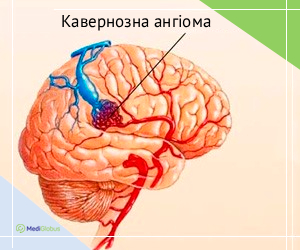 canvernous_angioma_ukr Що таке кавернозна ангіома мозку?