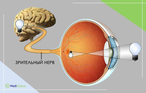 Что такое неврит зрительного нерва