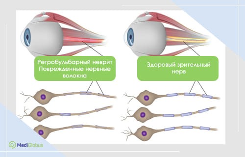 Что такое неврит зрительного нерва. Симптомы заболевания