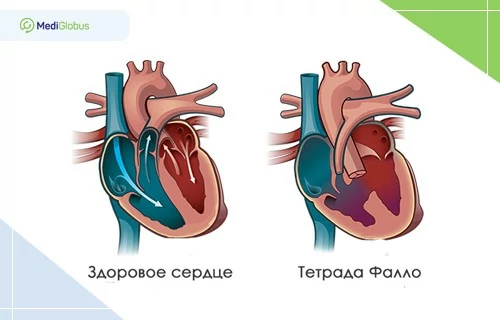 Сколько стоит операция при тетраде Фало за рубежом