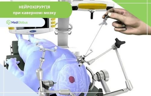 Лікування каверноми головного мозку в Туреччині 3D-ілюстрація нейрохірургічної операції при каверномі головного мозку