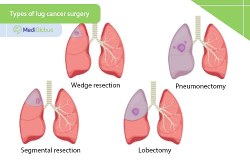 types of lung cancer surgery