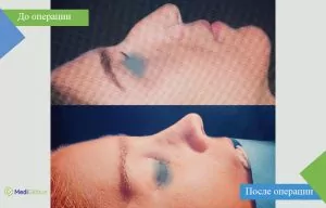 ринопластика в Турции фотографии до и после ринопластики