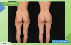 подтяжка тела в Турции фотографии до и после подтяжки тела