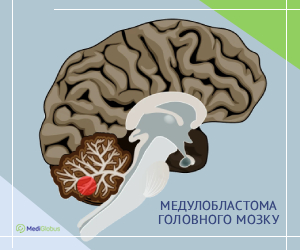 brain_meduloblastoma_ukr Медулобластома головного мозку