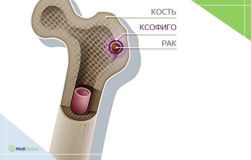 Как работае Радий-223 Ксофиго при лечении рака простаты, принцип действия