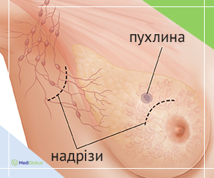 lumpectomy_ukr Як проводиться лампектомія при лікуванні раку грудей