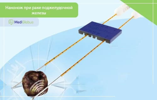 Нанонож при раке поджелудочной железы — показания, эффективность, цены и клиники
