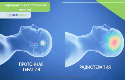 сравнение протонной терапии и стандартного облучения Визуализация воздействия облучения на опухоль и окружающие ткани в головном мозге: слева протонная терапия, справа радиотерапия