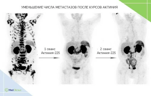 Результаты после лечения рака простаты Актинием-225 Три ПЭТ-снимка тела пациента до и после лечения Актинием‑225: на первом видны множественные очаги метастазов, на втором и третьем их число заметно уменьшается после 1 и 2 сеансов терапии