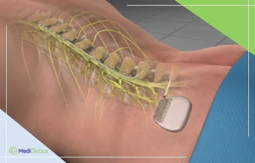 новый эффективный метод лечения хронической боли 3D-визуализация нейростимулятора спинного мозга с электродами вдоль позвоночника