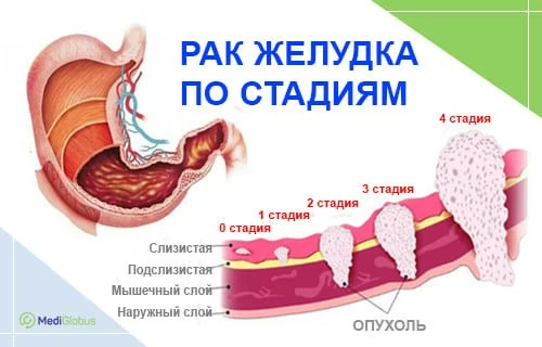 Стадии рака желудка Схематическое изображение желудка человека с опухолями на разных стадиях