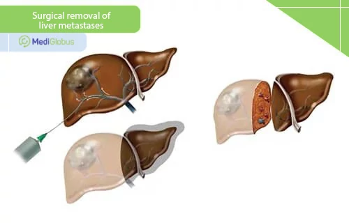 surgical removal of liver metastases