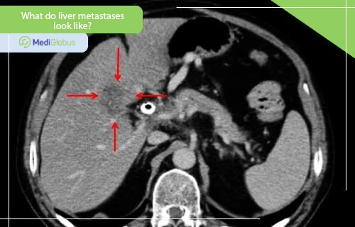 what do liver metastases look like