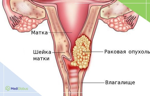 начальная стадия рака шейки матки