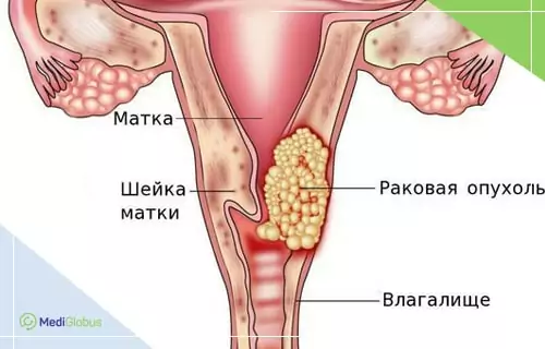 изображение опухоли шейки матки схематическое изображение женской половой системы с опухолью, расположенной в области шейки матки