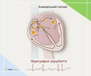 atrial_fibr_ukr Як виглядає фібріляція передсердь схема