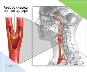 caratoid_atersclr_ukr Як вигядає атеросклероз сонної артерії