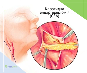 cea_ukr Як виглядає каротидна енлаеректомія операція